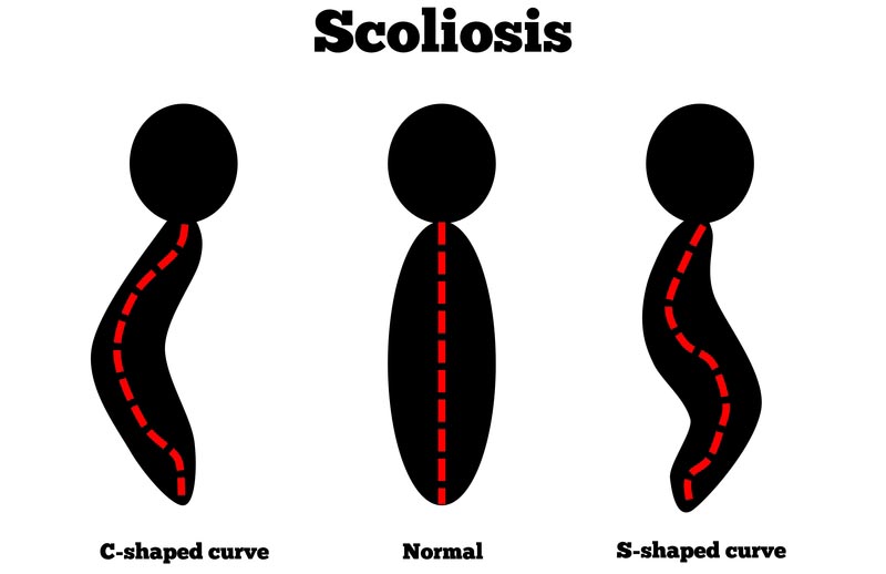 Scottsdale, 85254 scoliosis treatment